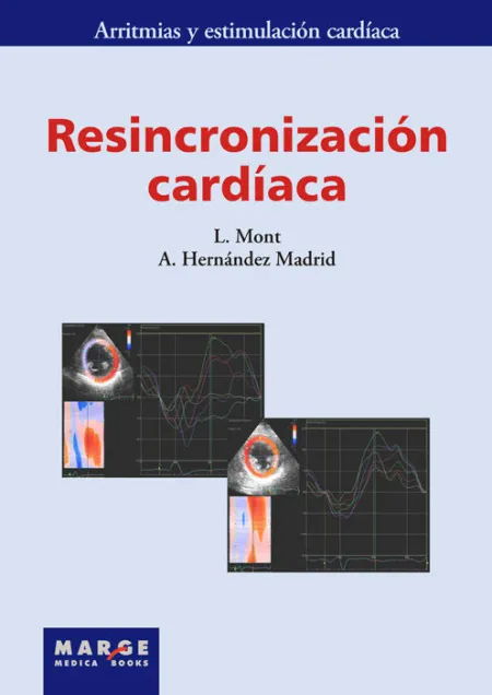 Resincronización Cardíaca