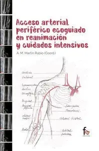 Acceso Arterial Periférico Ecoguiado en Reanimación y Cuidad